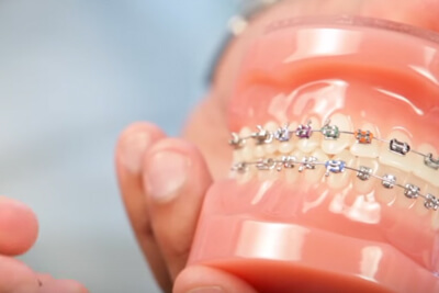 Is your braces wire poking you? Here's some at-home tips to help