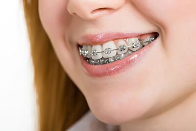Are Invisalign Braces the Best Option for Overbite Treatment