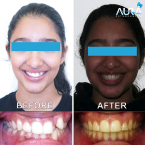 h | Aura Orthodontics